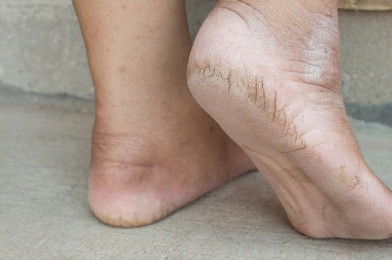 Home Remedies For Cracked Heels