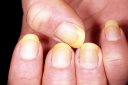 Causes Of Yellow Nails