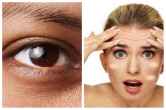 Symptoms of Iron Deficiency: आंखो के नीचे काले घेरे और स्किन पर सफेद दाग, इशारा है आयरन की कमी का, जानें अन्य लक्षण