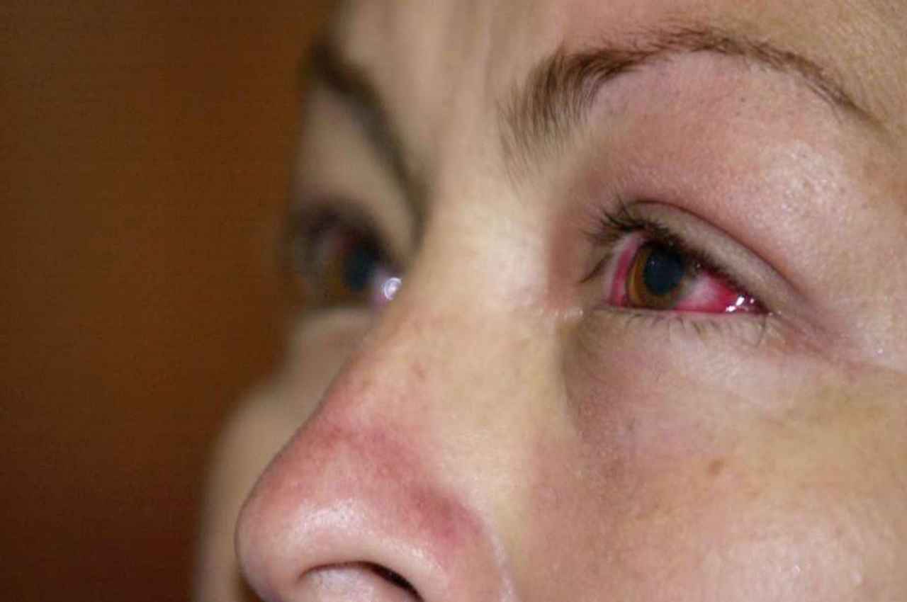 Bad effect of Rubbing eyes: बार-बार आंख रगड़ने से हो सकते हैं अंधे, जानें इसके अन्य नुकसान