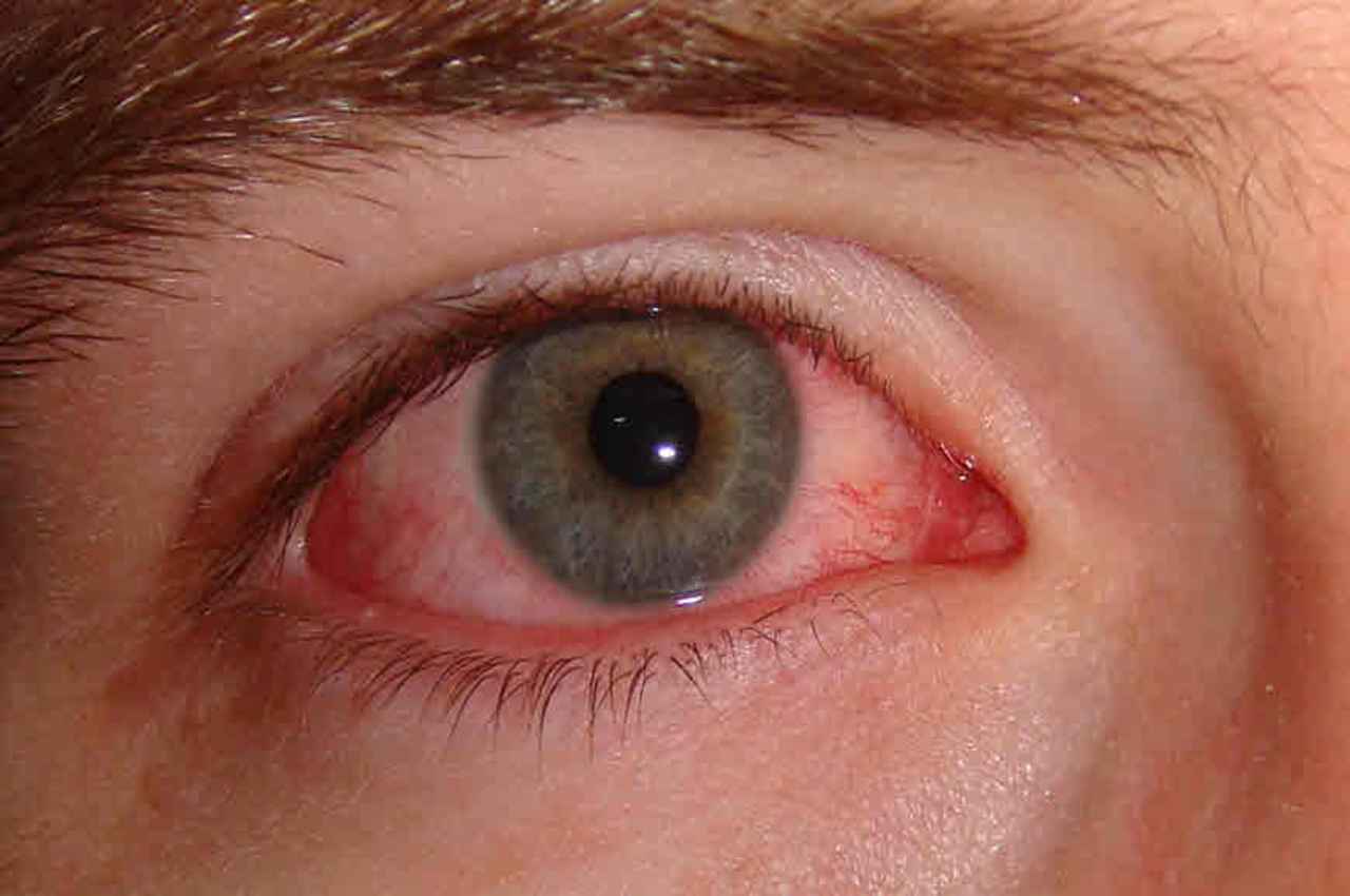 Glaucoma Symptoms: आपको दिख रहा है डबल-डबल तो हो सकती है आंखों की ये गंभीर बीमारी, जानें विस्तार से  