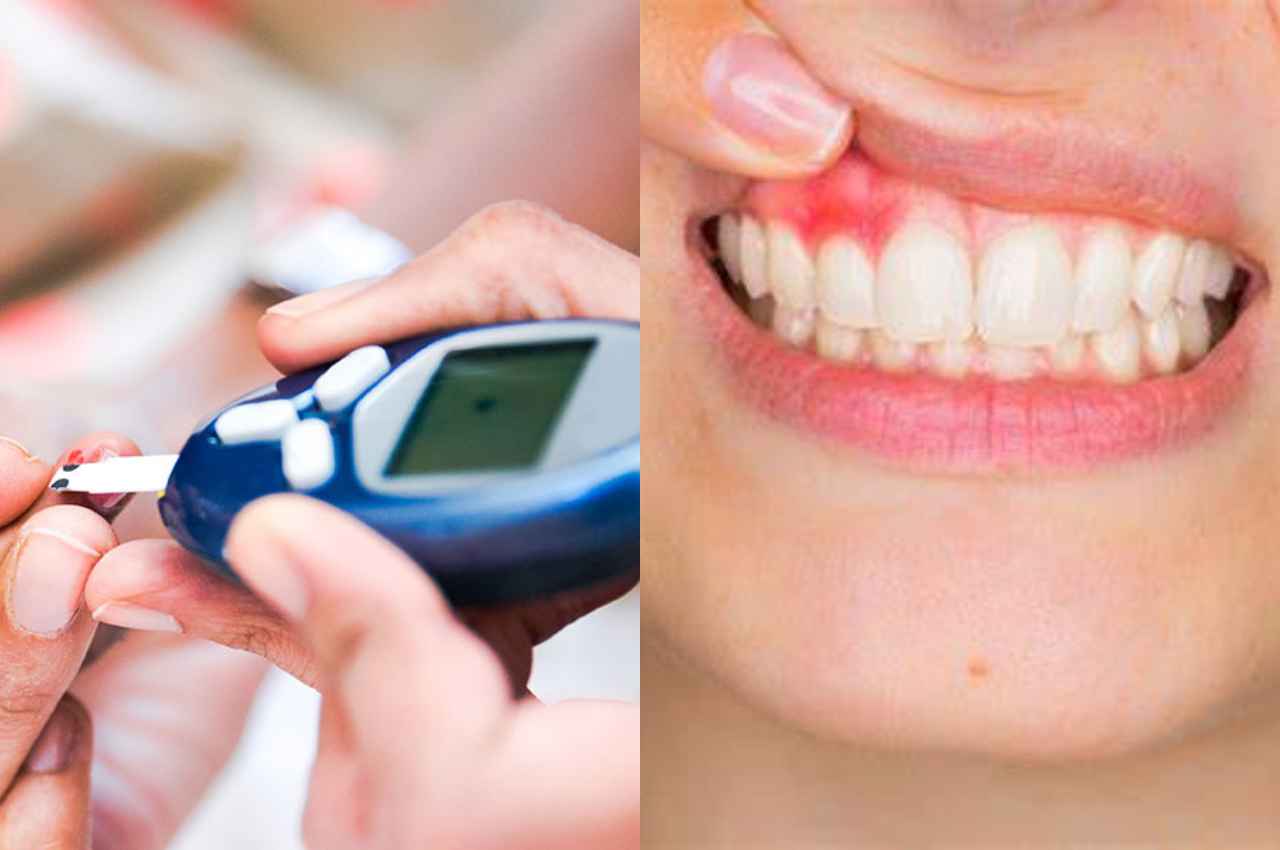 Oral Care In Diabetes: शुगर लेवल बढ़ने पर मसूड़ों से आने लगता है ब्लड, इस बीमारी में अच्छे से करें ओरल केयर