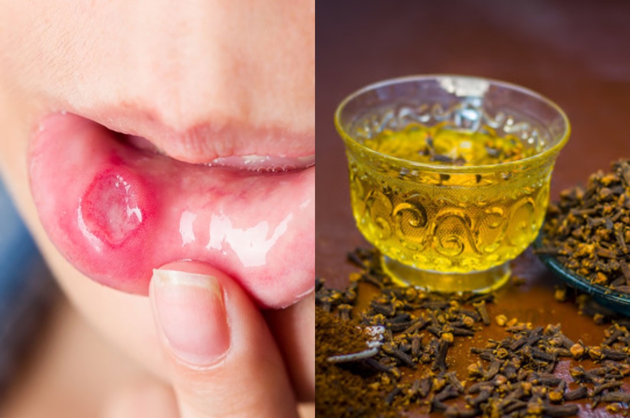 Health Tips, Mouth Ulcer, Home Remedies