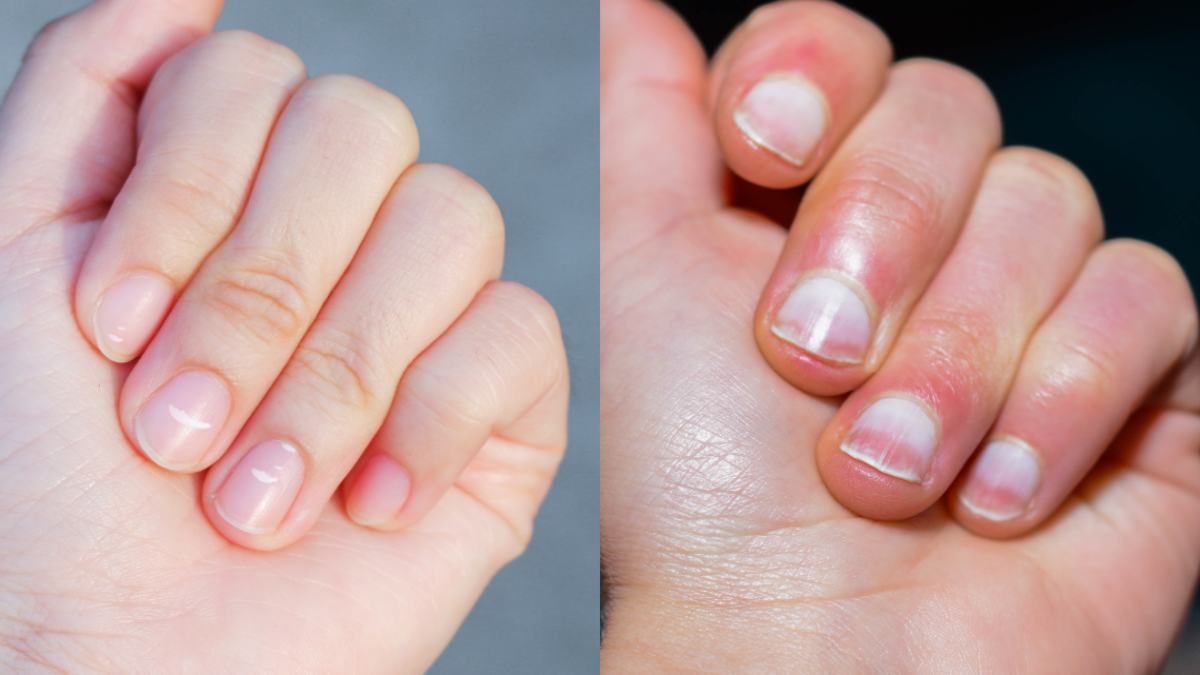 Those White Marks On Your Nails Don't Appear Because Of Calcium Deficiency.  Here's The Actual Reason - ScoopWhoop