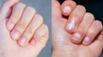 white spots causes, nails white spots diseases, nails white spots reasons, white spots on nails